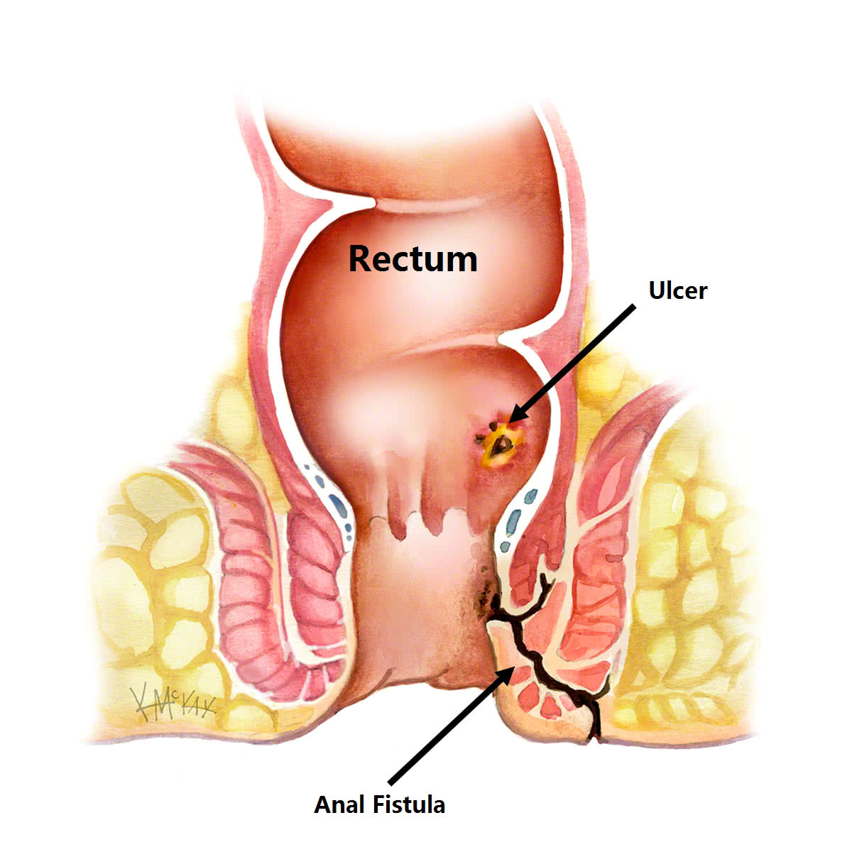Fistula